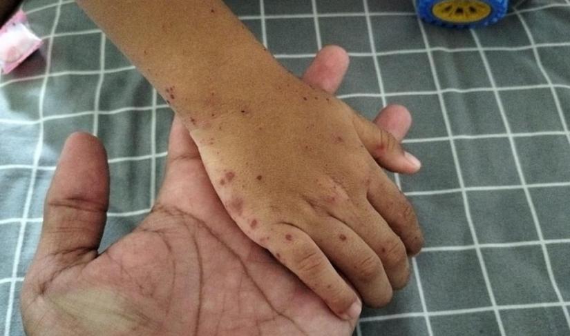 Flu Singapura.